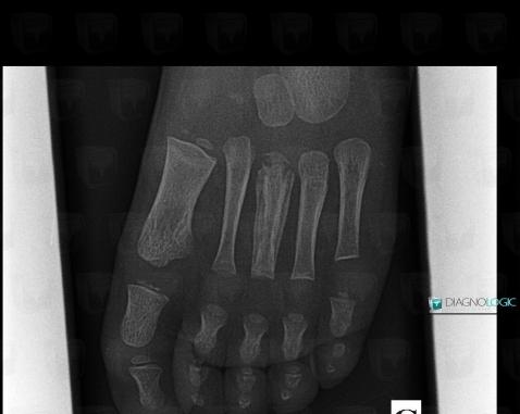 Osteomyelitis, Metatarsal bones, X rays