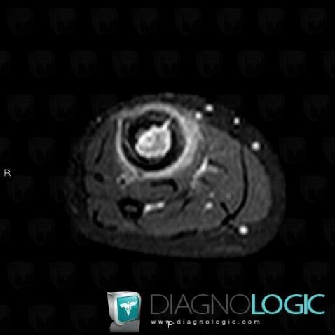 Osteomyelitis, Muscles - Leg, Other soft tissues/nerves - Leg, MRI