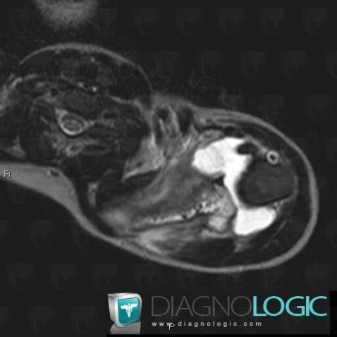 Osteomyelitis, Scapula, Other soft tissues/nerves - Shoulder, MRI