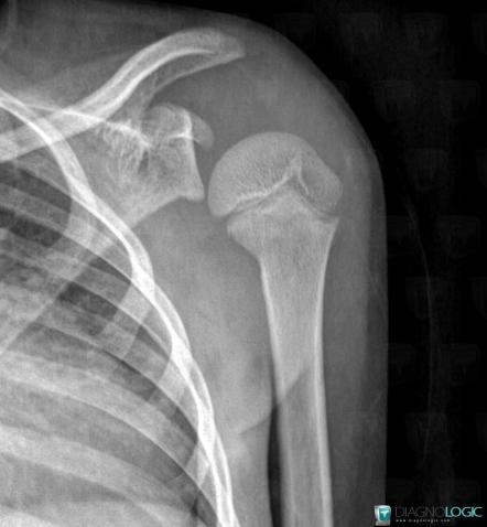 Osteomyelitis, Scapula, X rays