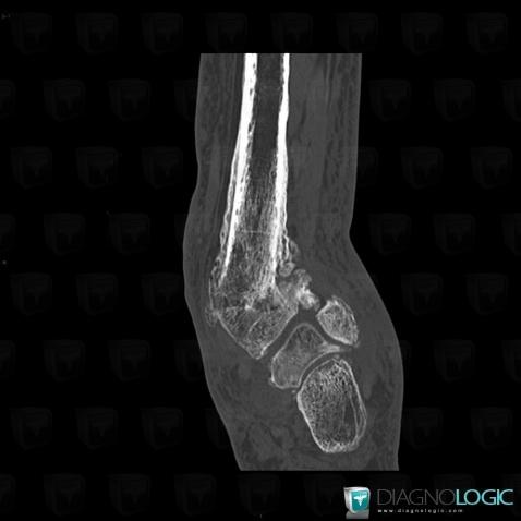 Osteomyelitis, Tibia - Distal part, CT