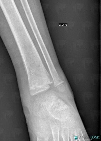 Osteomyelitis, Tibia - Distal part, X rays