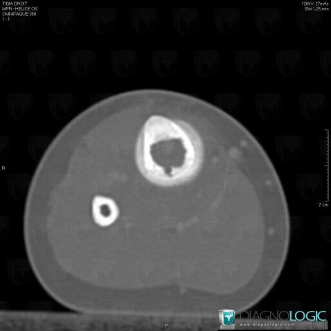 Osteomyelitis, Tibia - Mid part, CT