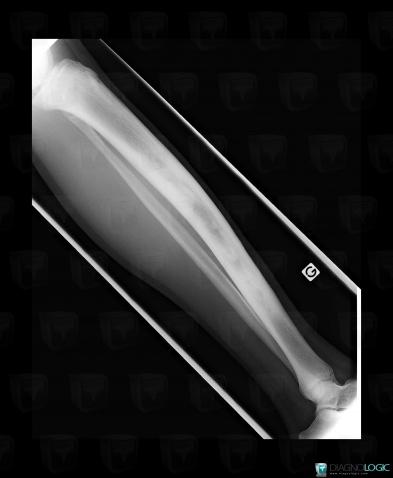 Osteomyelitis, Tibia - Mid part, X rays