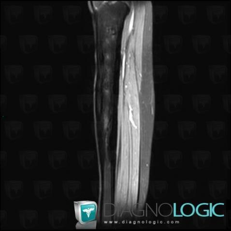 Osteomyelitis, Tibia - Proximal part, Tibia - Mid part, MRI