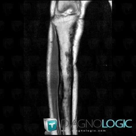 Osteomyelitis, Tibia - Proximal part, Tibia - Mid part, MRI