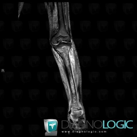 Osteomyelitis, Tibia - Proximal part, Tibia - Mid part, MRI