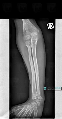 Osteomyelitis, Ulna - Mid part, X rays