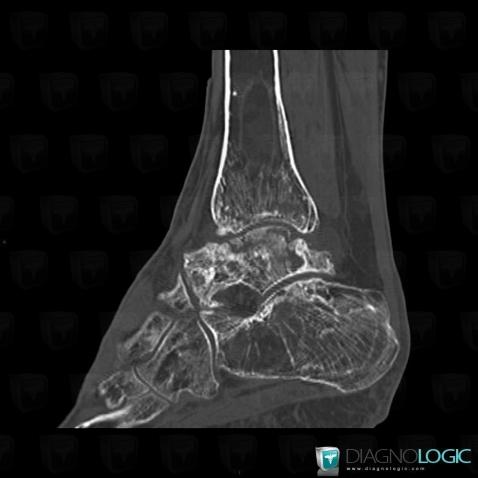 Ostéonécrose, Tibia -inférieur, Calcanéus, Scanner