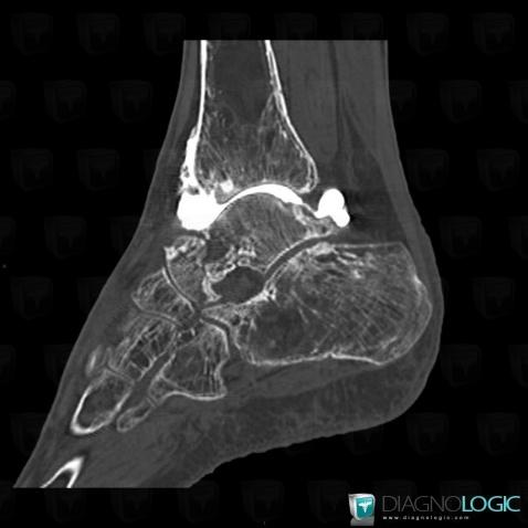 Ostéonécrose, Tibia -inférieur, Scanner