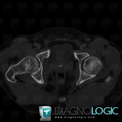 Osteopoikilosis, Femur - Proximal part, CT