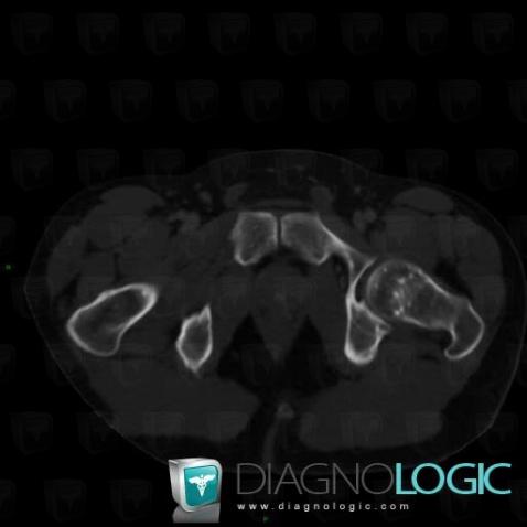 Osteopoikilosis, Femur - Proximal part, CT