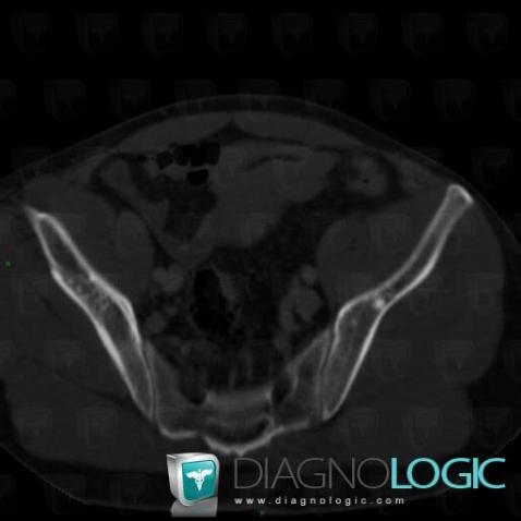 Osteopoikilosis, Ilium, CT