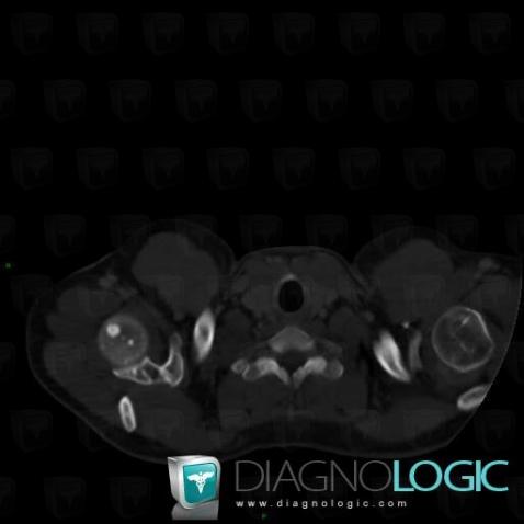 Osteopoikilosis, Scapula, Humerus - Proximal part, CT