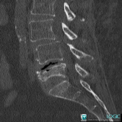 Osteoporosis, Vertebral body / Disk, CT