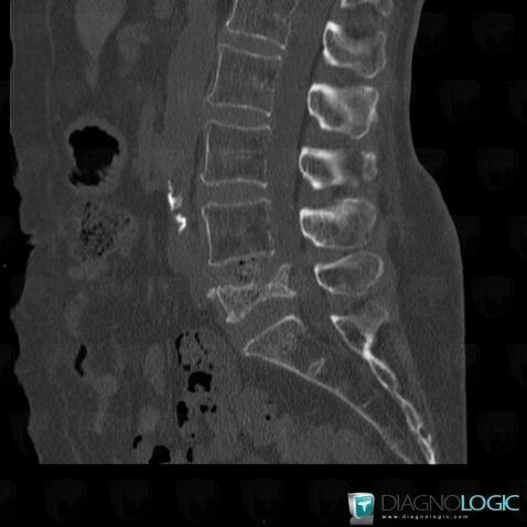 Osteoporosis, Vertebral body / Disk, CT