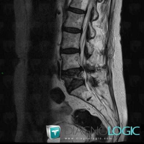 Osteoporosis, Vertebral body / Disk, MRI