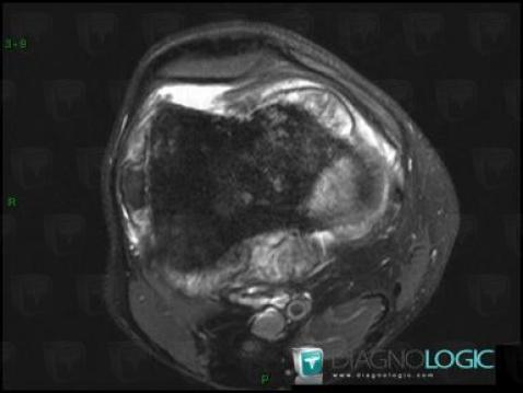 Osteosarcoma, Femur - Distal part, MRI