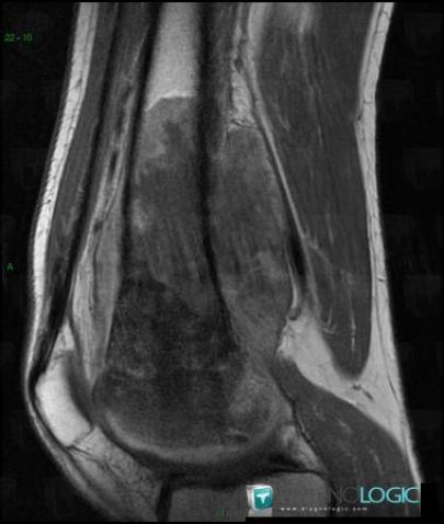 Osteosarcoma, Femur - Distal part, MRI