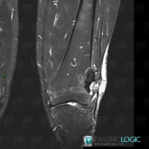 Osteosarcoma, Femur - Distal part, MRI