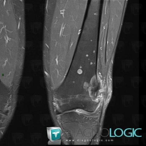 Osteosarcoma, Femur - Distal part, MRI