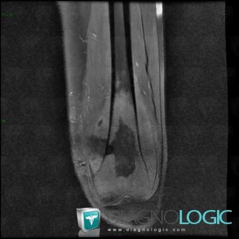 Osteosarcoma, Femur - Distal part, MRI