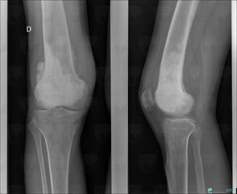 Osteosarcoma, Femur - Distal part, X rays