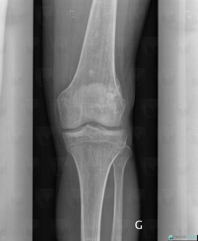 Osteosarcoma, Femur - Distal part, X rays