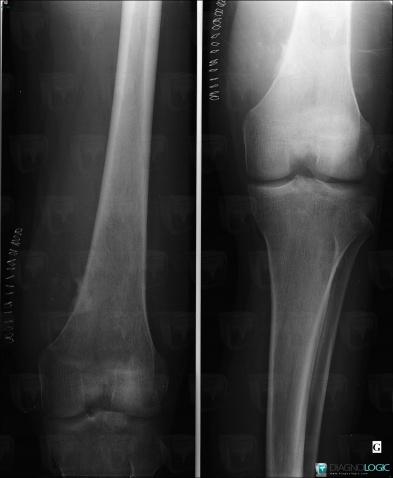 Osteosarcoma, Femur - Distal part, X rays