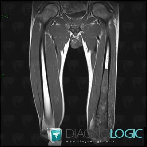 Osteosarcoma, Femur - Mid part, Femur - Distal part, MRI