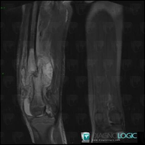 Osteosarcoma, Femur - Mid part, MRI