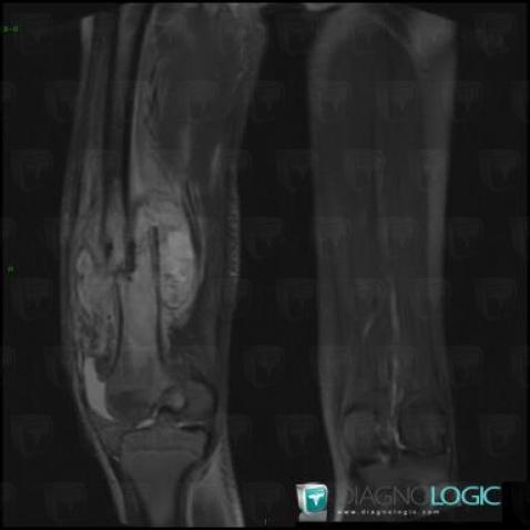 Osteosarcoma, Femur - Mid part, MRI