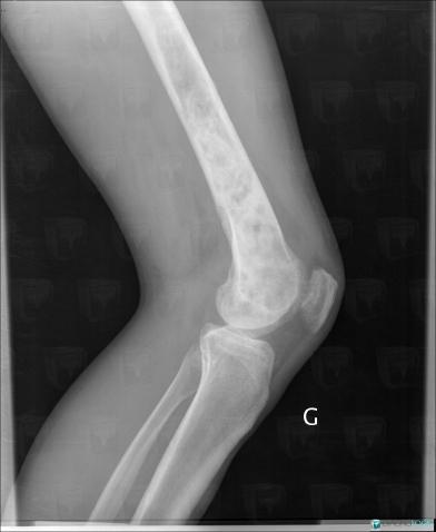 Osteosarcoma, Femur - Mid part, X rays