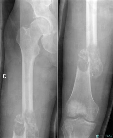 Osteosarcoma, Femur - Mid part, X rays