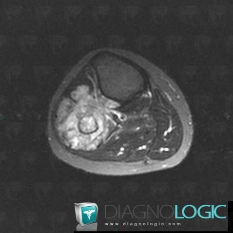 Osteosarcoma, Fibula - Proximal part, MRI