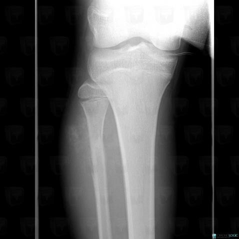 Osteosarcoma, Fibula - Proximal part, Muscles - Leg, X rays