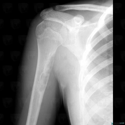 Osteosarcoma, Humerus - Mid part, X rays