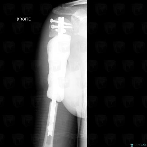 Osteosarcoma, Humerus - Mid part, X rays