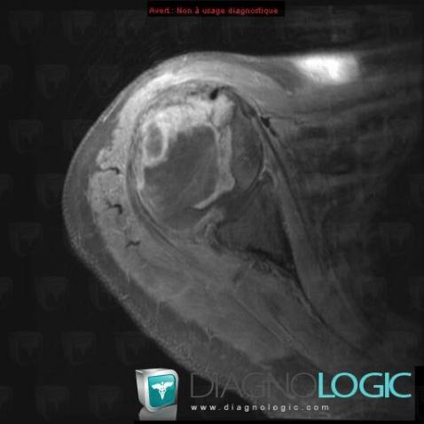 Osteosarcoma, Humerus - Proximal part, MRI