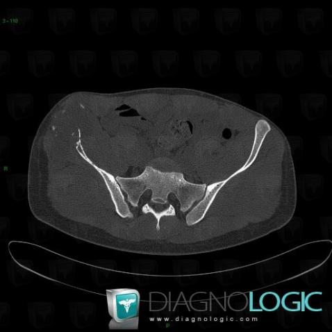 Osteosarcoma, Ilium, CT