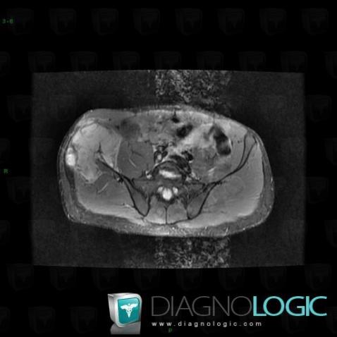 Osteosarcoma, Ilium, MRI