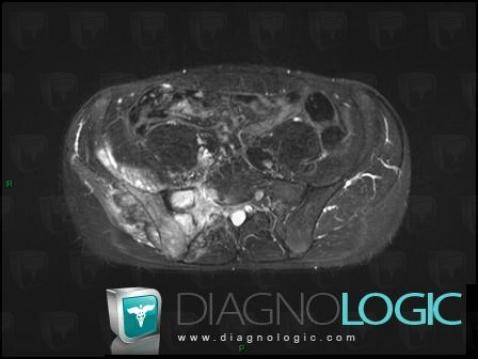 Osteosarcoma, Ilium, MRI