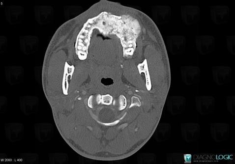 Osteosarcoma, Maxilla, CT