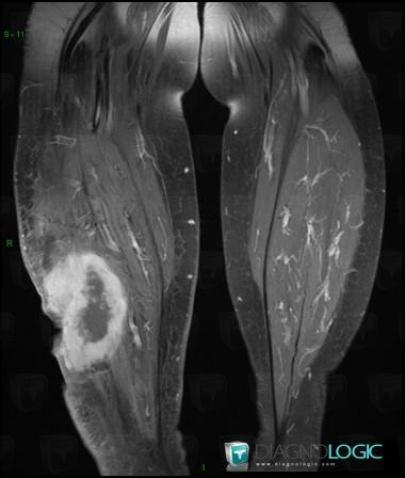 Osteosarcoma, Muscles - Leg, Other soft tissues/nerves - Leg, MRI