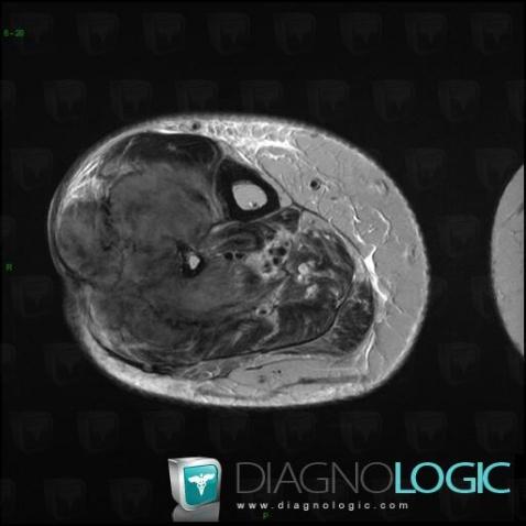 Osteosarcoma, Muscles - Leg, Other soft tissues/nerves - Leg, MRI
