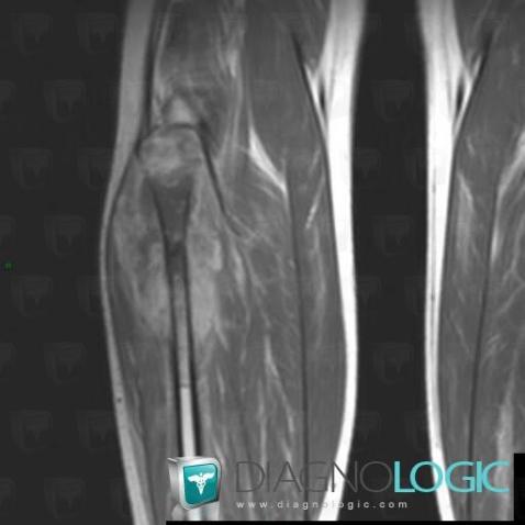 Osteosarcoma, Muscles - Leg, Other soft tissues/nerves - Leg, MRI