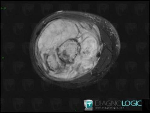 Osteosarcoma, Muscles - Thigh, Other soft tissues/nerves - Thigh, MRI