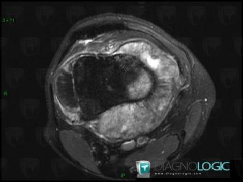 Osteosarcoma, Other soft tissues/nerves - Knee, MRI