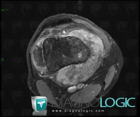 Osteosarcoma, Other soft tissues/nerves - Knee, MRI