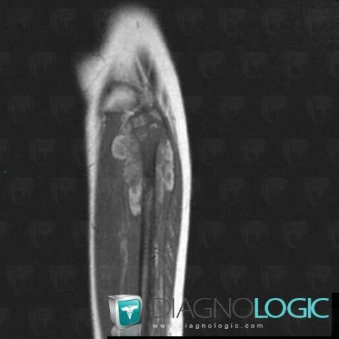 Osteosarcoma, Other soft tissues/nerves - Leg, MRI